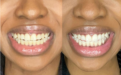 Crest Whitening Emulsions Before After 3